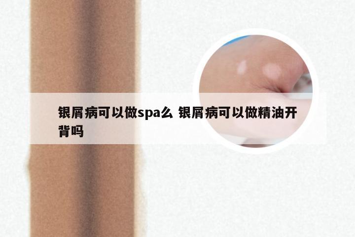 银屑病可以做spa么 银屑病可以做精油开背吗