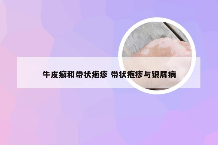 牛皮癣和带状疱疹 带状疱疹与银屑病