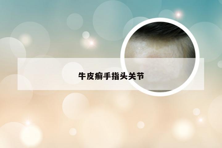牛皮癣手指头关节