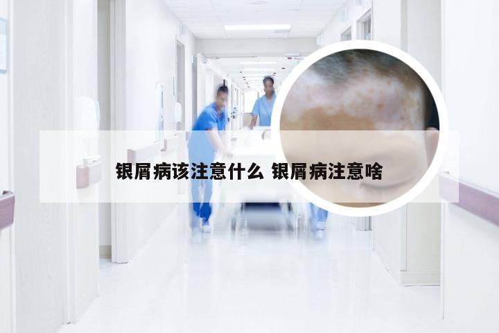 银屑病该注意什么 银屑病注意啥