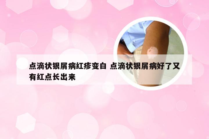 点滴状银屑病红疹变白 点滴状银屑病好了又有红点长出来