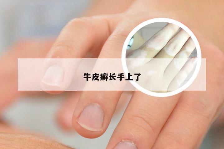牛皮癣长手上了