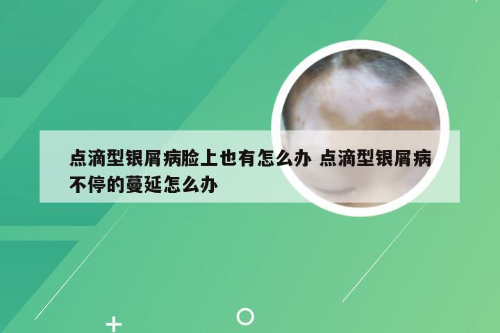 点滴型银屑病脸上也有怎么办 点滴型银屑病不停的蔓延怎么办