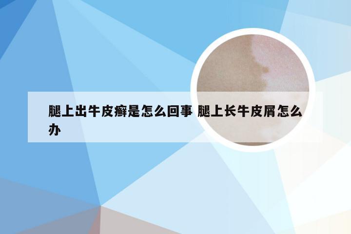 腿上出牛皮癣是怎么回事 腿上长牛皮屑怎么办