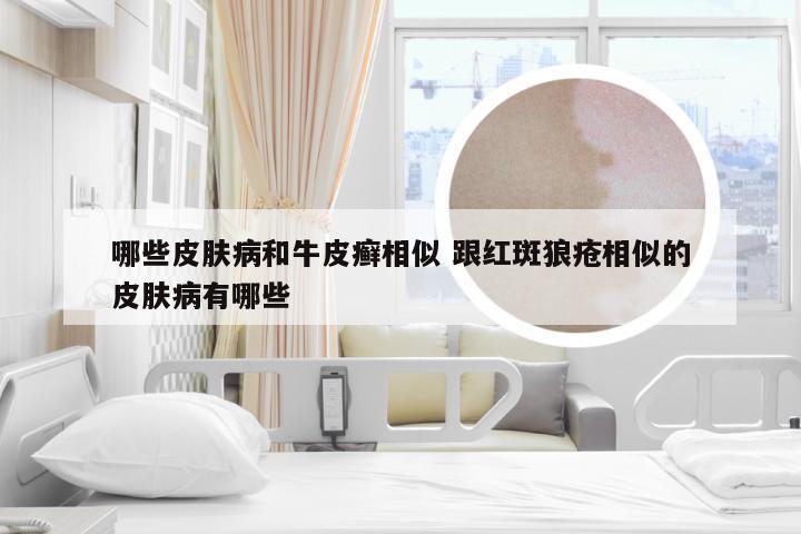 哪些皮肤病和牛皮癣相似 跟红斑狼疮相似的皮肤病有哪些