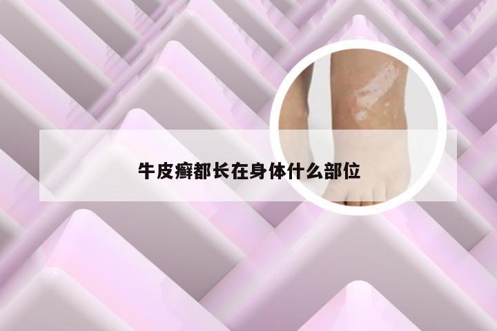 牛皮癣都长在身体什么部位