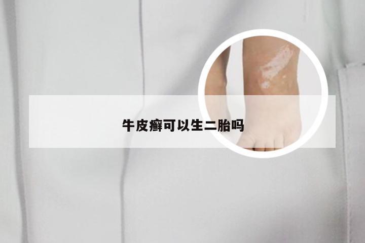 牛皮癣可以生二胎吗