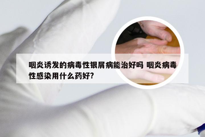 咽炎诱发的病毒性银屑病能治好吗 咽炎病毒性感染用什么药好?