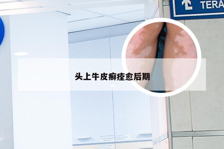 头上牛皮癣痊愈后期