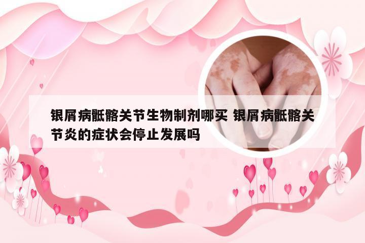 银屑病骶髂关节生物制剂哪买 银屑病骶髂关节炎的症状会停止发展吗