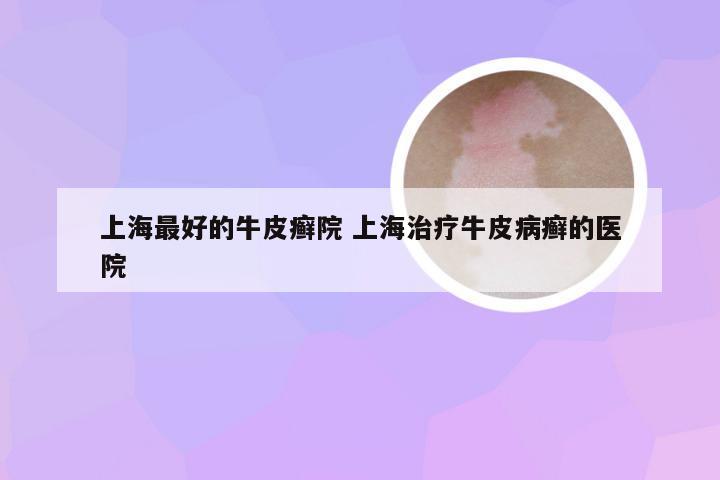 上海最好的牛皮癣院 上海治疗牛皮病癣的医院