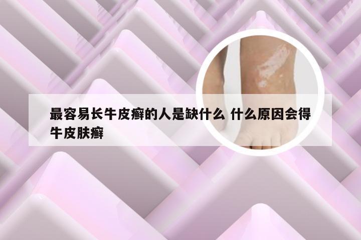 最容易长牛皮癣的人是缺什么 什么原因会得牛皮肤癣