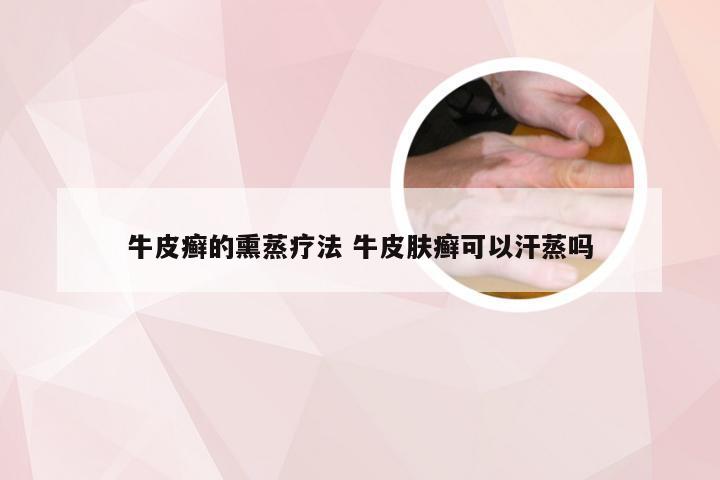 牛皮癣的熏蒸疗法 牛皮肤癣可以汗蒸吗