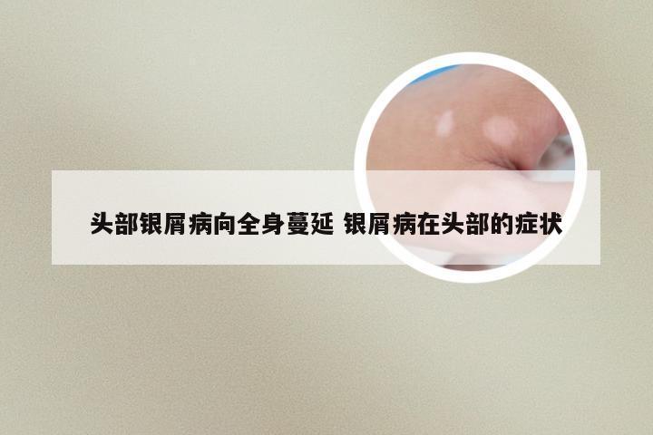 头部银屑病向全身蔓延 银屑病在头部的症状