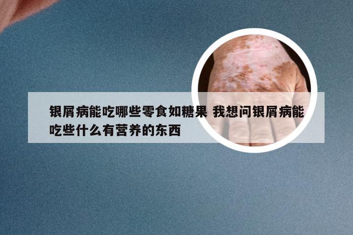 银屑病能吃哪些零食如糖果 我想问银屑病能吃些什么有营养的东西