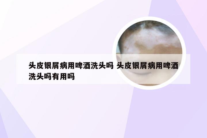 头皮银屑病用啤酒洗头吗 头皮银屑病用啤酒洗头吗有用吗