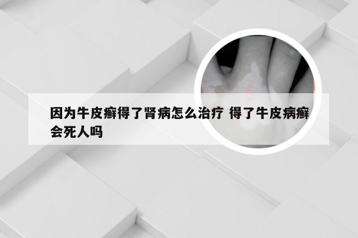 因为牛皮癣得了肾病怎么治疗 得了牛皮病癣会死人吗