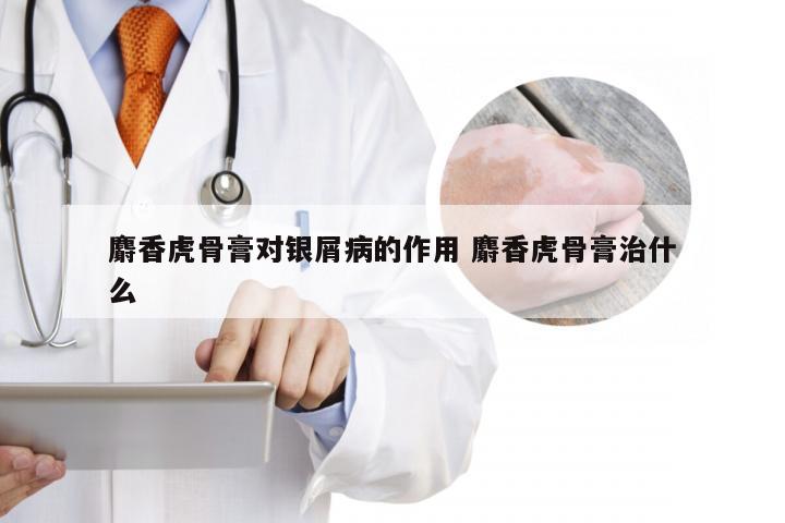 麝香虎骨膏对银屑病的作用 麝香虎骨膏治什么