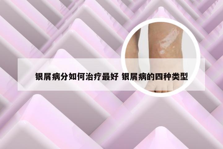 银屑病分如何治疗最好 银屑病的四种类型