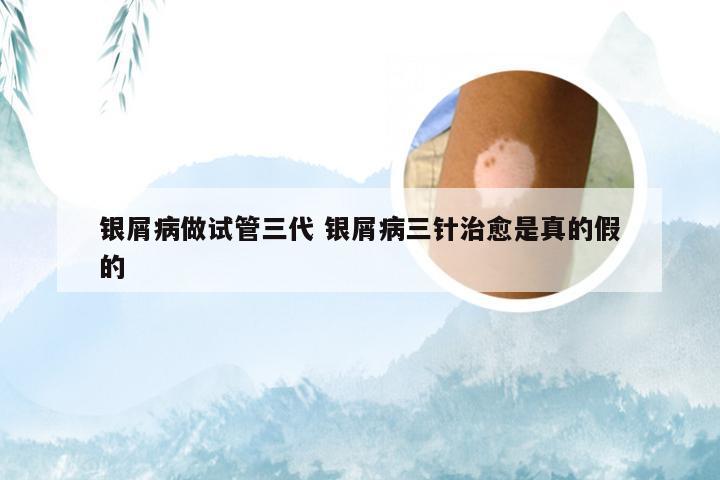 银屑病做试管三代 银屑病三针治愈是真的假的