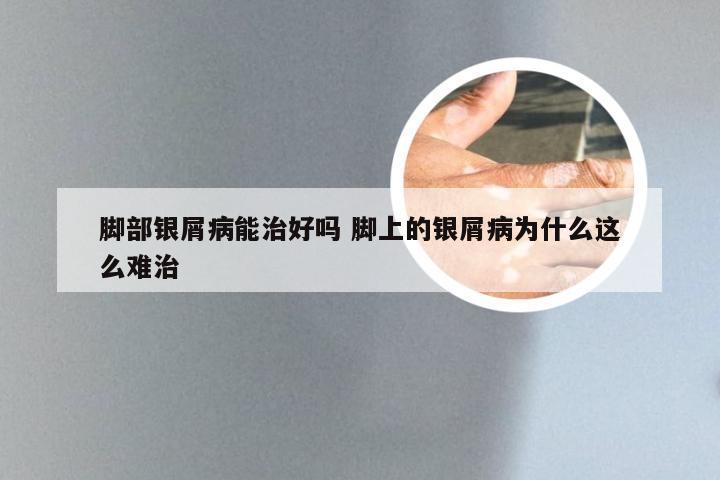 脚部银屑病能治好吗 脚上的银屑病为什么这么难治