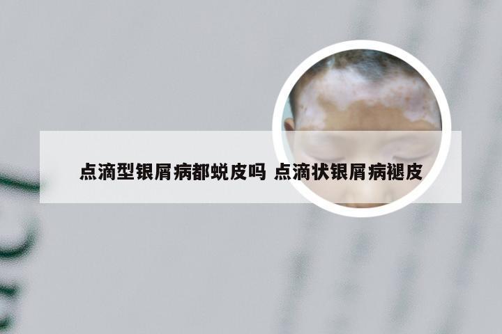 点滴型银屑病都蜕皮吗 点滴状银屑病褪皮