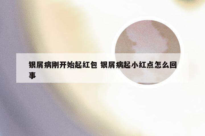 银屑病刚开始起红包 银屑病起小红点怎么回事
