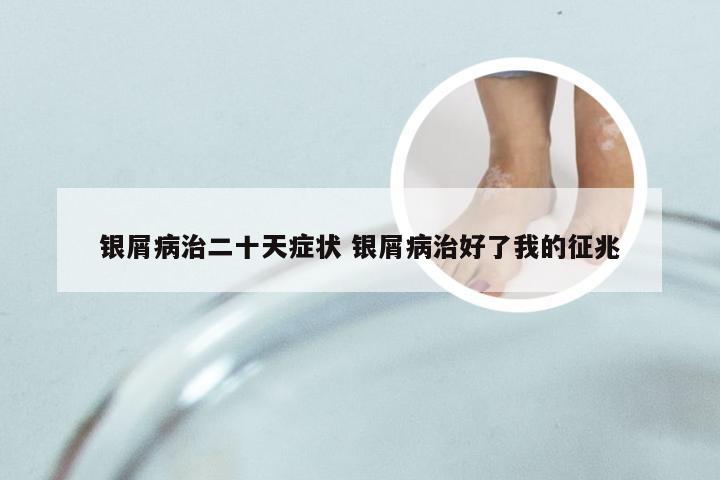 银屑病治二十天症状 银屑病治好了我的征兆