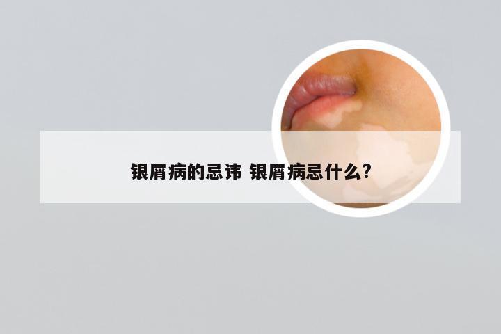 银屑病的忌讳 银屑病忌什么?