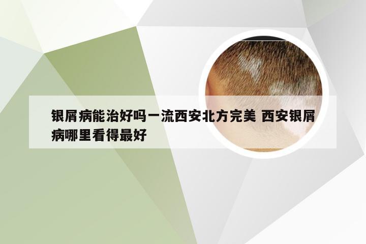 银屑病能治好吗一流西安北方完美 西安银屑病哪里看得最好