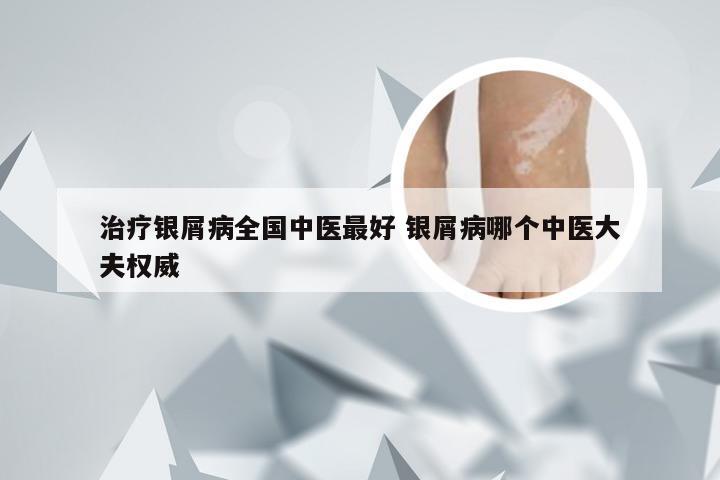 治疗银屑病全国中医最好 银屑病哪个中医大夫权威