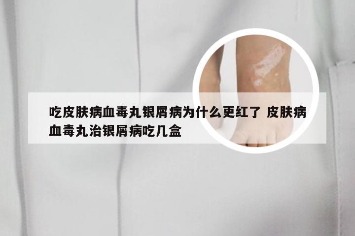 吃皮肤病血毒丸银屑病为什么更红了 皮肤病血毒丸治银屑病吃几盒