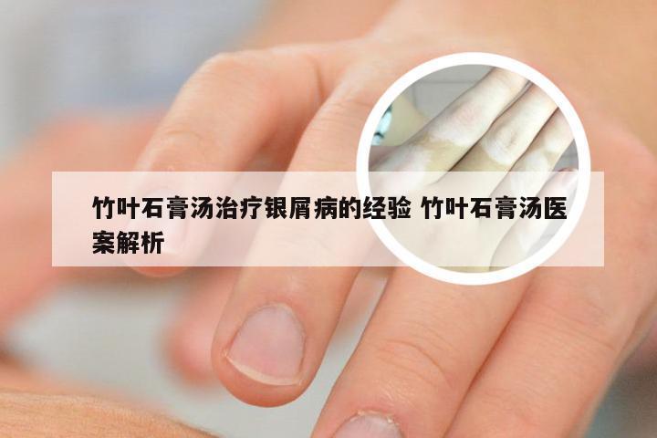 竹叶石膏汤治疗银屑病的经验 竹叶石膏汤医案解析