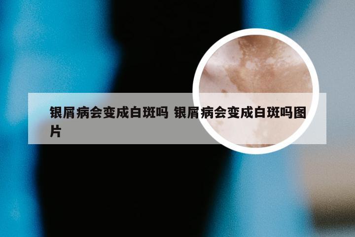 银屑病会变成白斑吗 银屑病会变成白斑吗图片