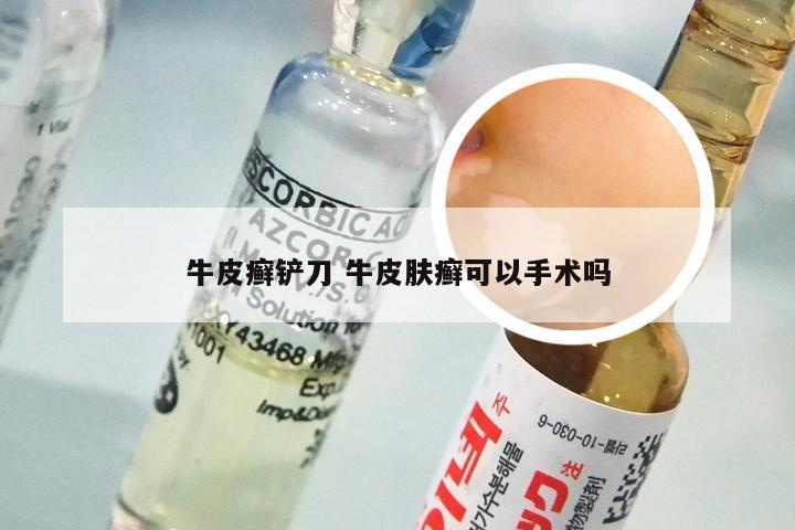 牛皮癣铲刀 牛皮肤癣可以手术吗