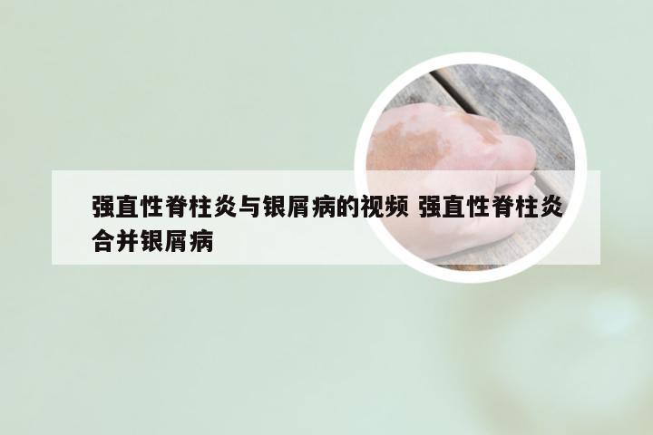 强直性脊柱炎与银屑病的视频 强直性脊柱炎合并银屑病