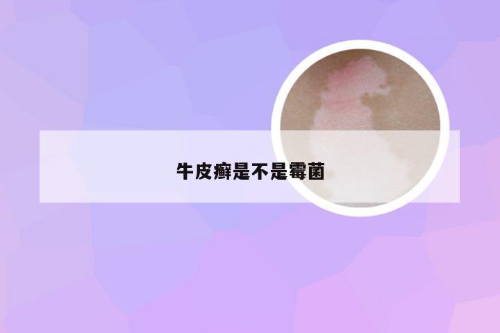 牛皮癣是不是霉菌