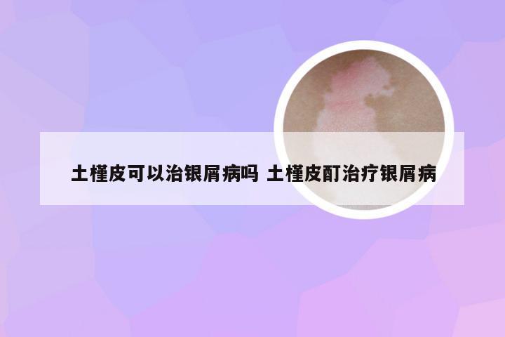 土槿皮可以治银屑病吗 土槿皮酊治疗银屑病