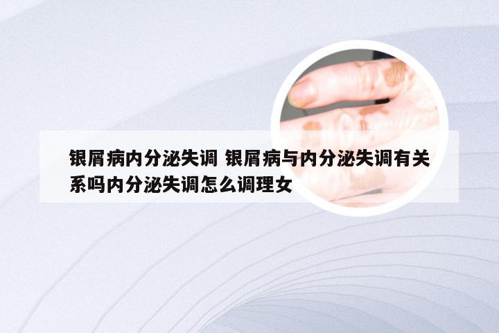 银屑病内分泌失调 银屑病与内分泌失调有关系吗内分泌失调怎么调理女