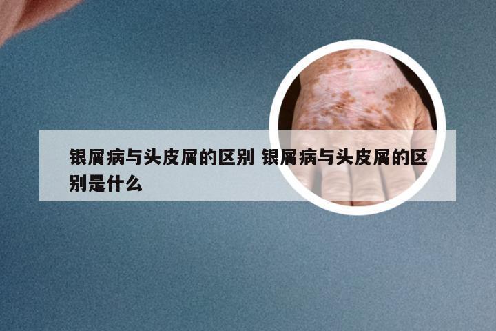 银屑病与头皮屑的区别 银屑病与头皮屑的区别是什么