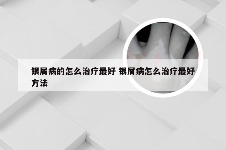 银屑病的怎么治疗最好 银屑病怎么治疗最好方法