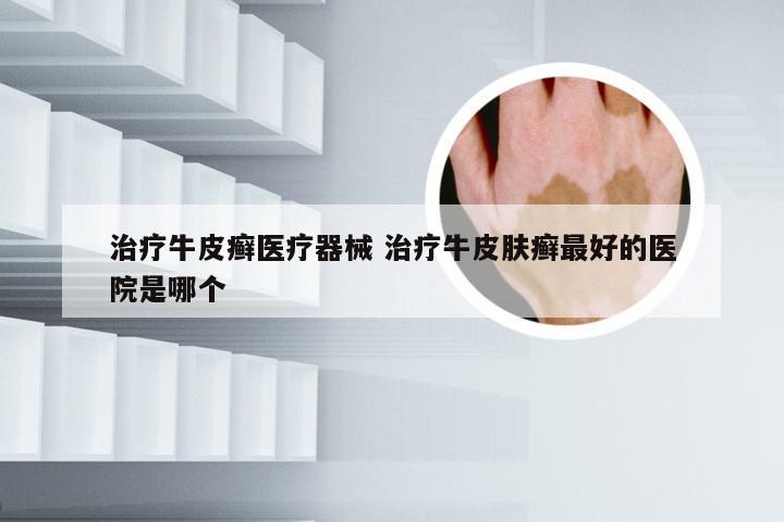治疗牛皮癣医疗器械 治疗牛皮肤癣最好的医院是哪个