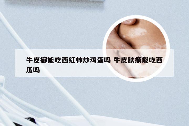 牛皮癣能吃西红柿炒鸡蛋吗 牛皮肤癣能吃西瓜吗