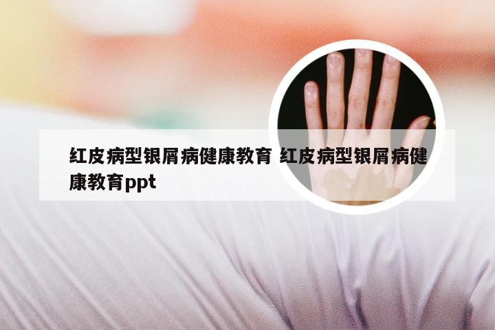 红皮病型银屑病健康教育 红皮病型银屑病健康教育ppt