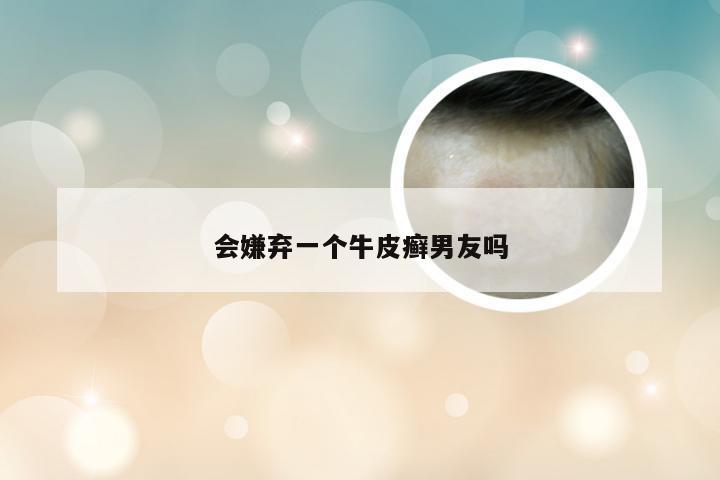 会嫌弃一个牛皮癣男友吗