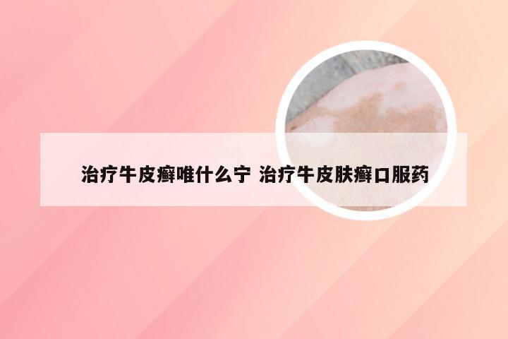 治疗牛皮癣唯什么宁 治疗牛皮肤癣口服药
