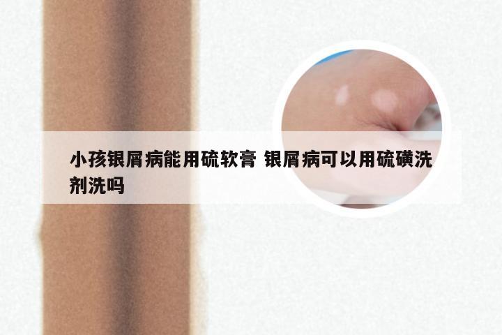小孩银屑病能用硫软膏 银屑病可以用硫磺洗剂洗吗