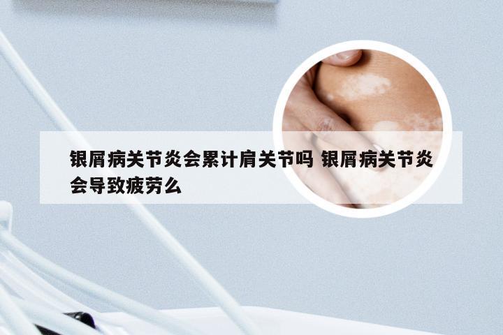 银屑病关节炎会累计肩关节吗 银屑病关节炎会导致疲劳么