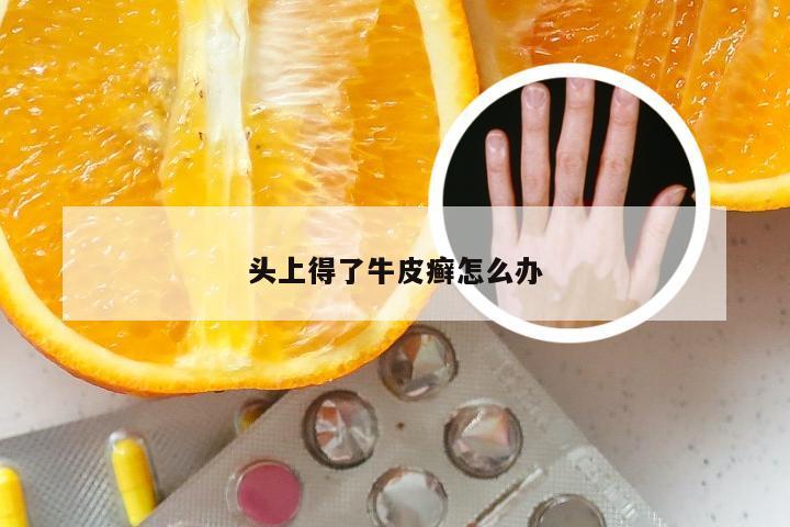 头上得了牛皮癣怎么办