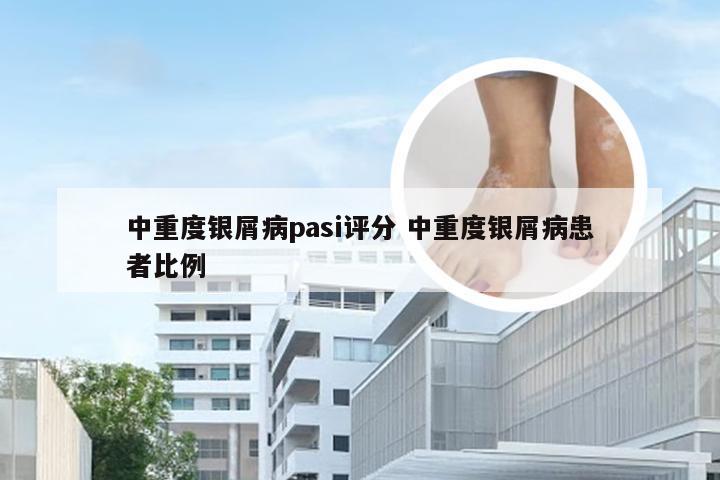 中重度银屑病pasi评分 中重度银屑病患者比例